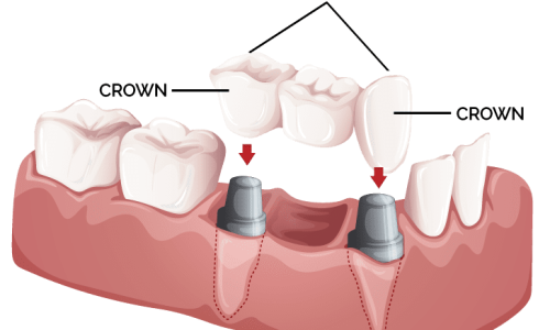 crowns-and-bridges